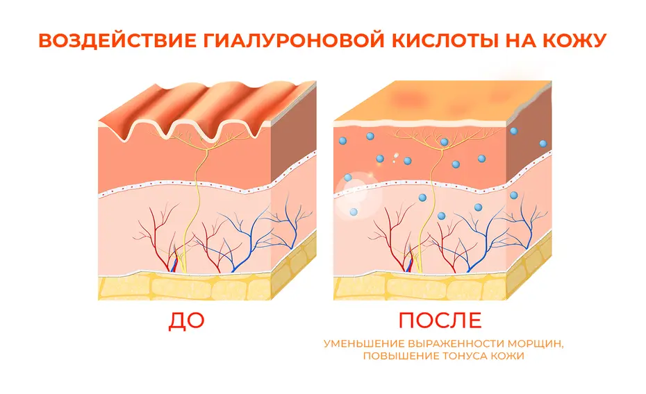 Схема показывает влияние гиалуроновой кислоты на кожу. Слева изображено состояние кожи до применения, с заметными морщинами. Справа – состояние после применения, с уменьшенными морщинами и улучшенным тоном кожи. Текст под изображением объясняет изменения.